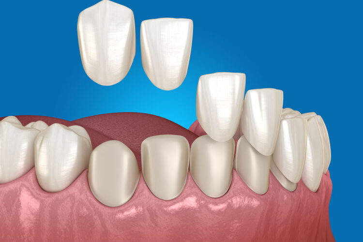 dental veneers