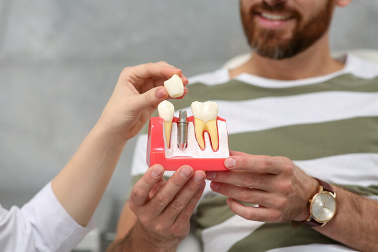 Doctor showing a dental implant model to a patient, representing a dental implant consultation at Deluxe Dental in Miami, Kendall, and Medley.