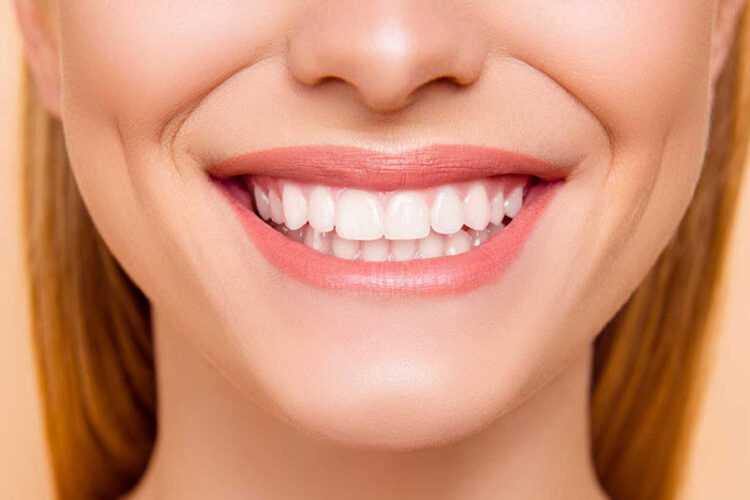 beautiful_smile_close_up representation of braces miami, result smile