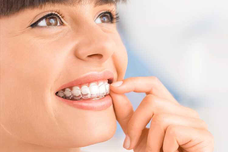 Beautiful woman putting on clear aligners, representing Invisalign treatment available at Deluxe Dental in Miami, Kendall, and Medley