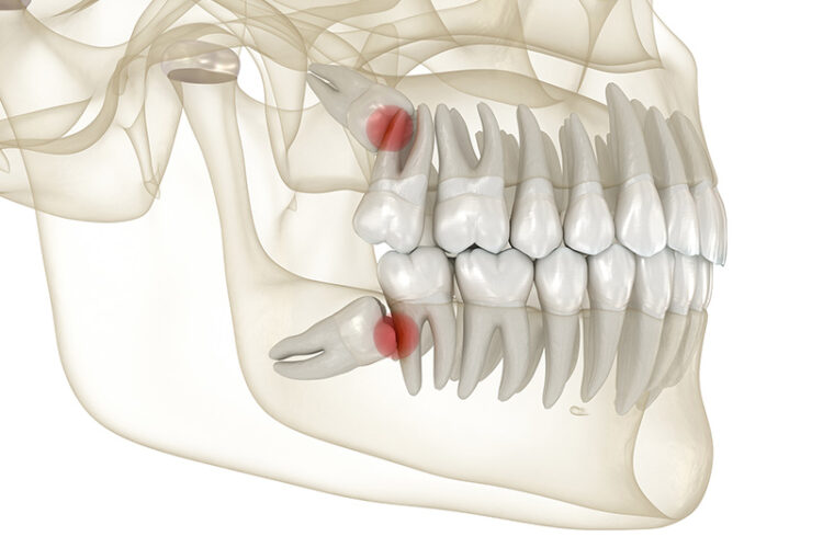 Wisdom Teeth Removal representation of impacted wisdom teeth miami dental office