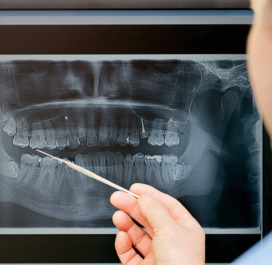 Wisdom Teeth Removal xray representation impacted wisdom tooth miami dental office