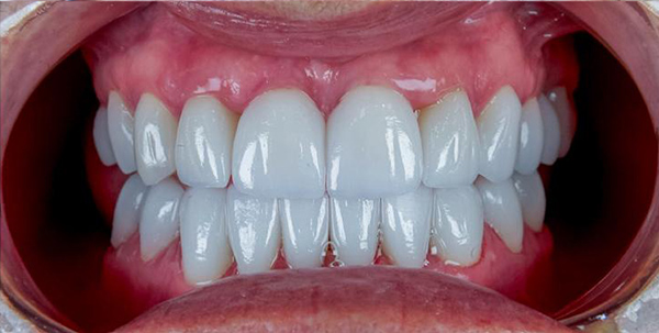 Beautiful Smile Close-up of a patient's transformed smile after smile design at Deluxe Dental in Medley, featuring a bright, symmetrical appearance.