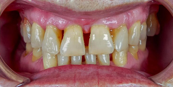 Close-up of a patient's smile before cosmetic dental treatment at Deluxe Dental in Miami, showing deteriorated smile, uneven and misaligned teeth.