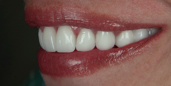 Patient's smile after smile design treatment at Deluxe Dental in Kendall, with perfectly aligned and whiter teeth