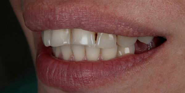 Patient's teeth before smile design treatment at Deluxe Dental in Kendall, showing uneven spacing and discoloration