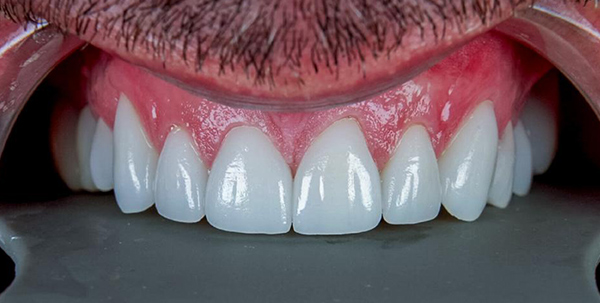 Patient's smile after smile design treatment at Deluxe Dental in Miami, featuring whiter, straighter teeth, natural looking smile.