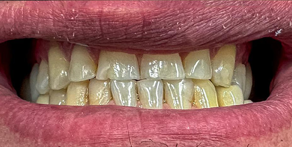Patient's teeth before smile design treatment at Deluxe Dental in Miami, showing discoloration and misalignment.